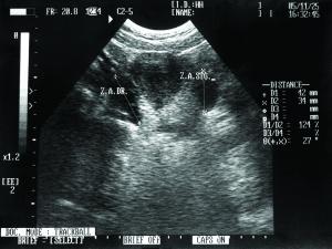 Pelvic ultrasound 