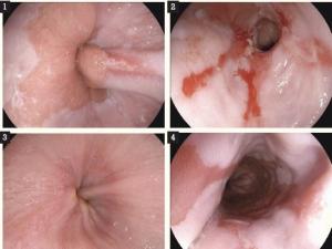 Oesophagitis