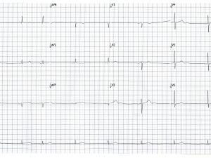 ECG