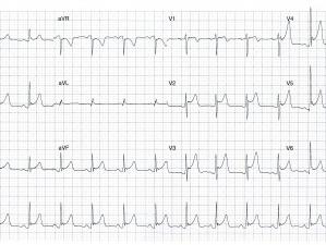 ECG