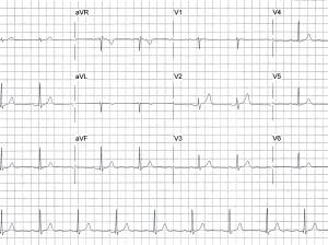 ECG 4 July