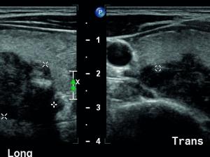 Posteriorly based right thyroid nodule