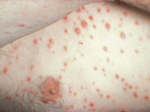 Secondary syphilis rash