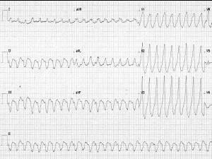 Heartbeat-ECG-260918