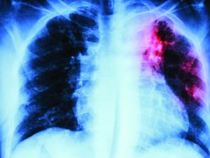 Pulmonary Tuberculosis