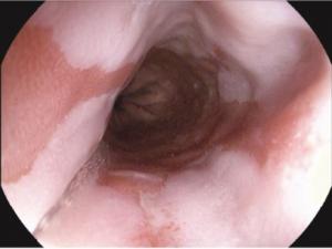 Barrett’s oesophagus