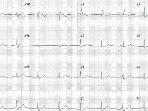 ECG