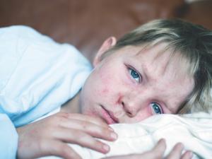 Boy with measles