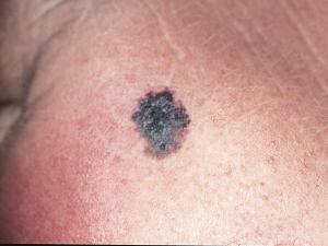 skin cancer