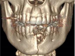 Broken jaw vaping