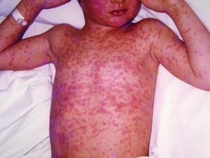 Child with measles