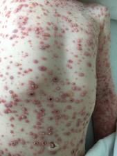 Measles patient 1 b