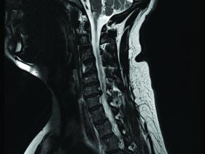 C6-C7 disc herniation