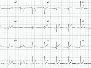 ECG Heartbeat