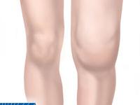 Arthritic Knee