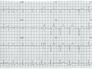 ECG Heartbeat 2011