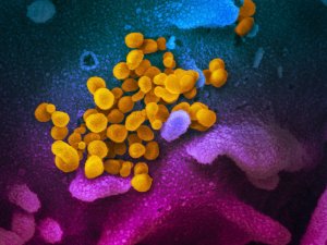 scanning electron microscope image shows SARS-CoV-2 (yellow)—also known as 2019-nCoV, the virus that causes COVID-19—isolated from a patient in the U.S., emerging from the surface of cells (blue/pink) cultured in the lab.  source us national institutes of health 