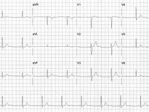 ECG heartbeat 12/2/20