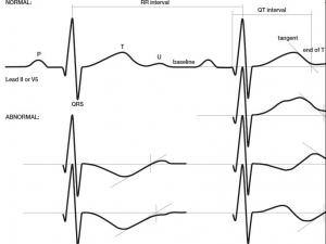 T wave for Heart