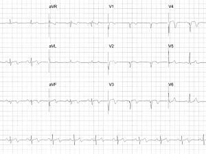 ECG heartbeat 11 March20