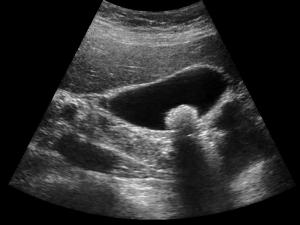 Ultrasound of gallbladder