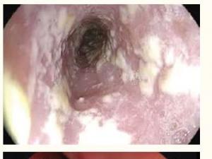 Oesophageal candidiasis and Circumferential ulceration in the midoesophagus,