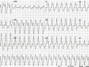 ECG heartbeat 0107