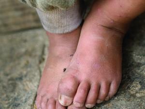 Child poverty, dirty bare feet