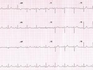 ECG heartbeat 2907