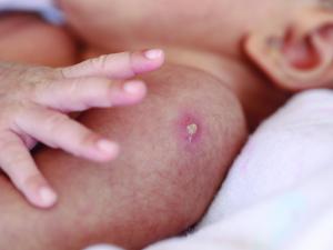 Pustules, BCG vaccination