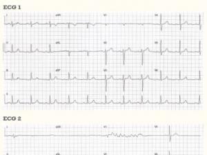 ECG Heartbeat 1908