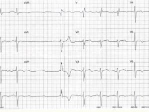 ECG Heartbeat 2209