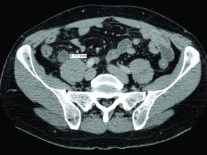 CT scan showing acute appendicitis