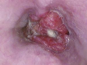 Adenocarcinoma