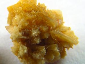 Kidney stone