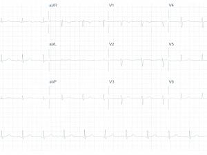 Heartbeat ECG 03032021