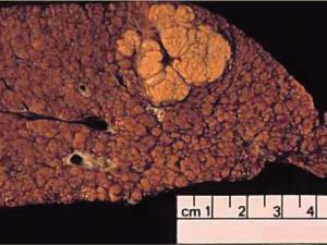 hepatocellular-carcinoma-organ