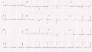 Heartbeat ECG