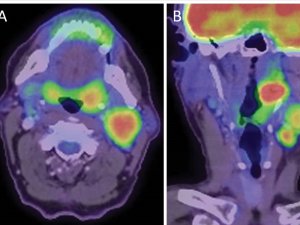 Figure 1. Axial (A) and coronal (B) PET-CT showing HPV-positive oropharyngeal squamous cell carcinoma affecting the left tonsil with metastases in the neck