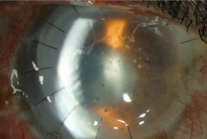 Graft rejection after penetrating keratoplasty. The cornea is cloudy with oedema and scattered keratic precipitates. Confluent conjunctival injection and corneal neovascularisation are present