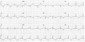 Heartbeat_ECG