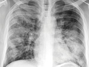 Other tests, such as chest x-rays to detect infection, add certainty to the diagnosis