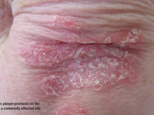 chronic plaque psoriasis