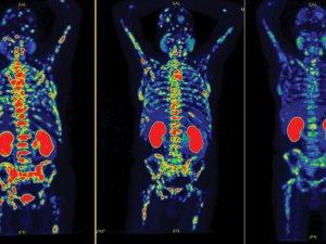 Progressive improvement in disease burden with lutetium-177 PSMA radioligand therapy. Left to right: baseline; midtreatment after two cycles; after four treatment cycles 