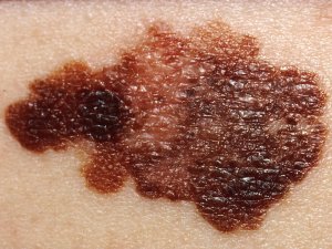 melanoma