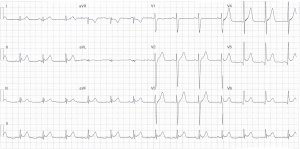 Heartbeat ECG