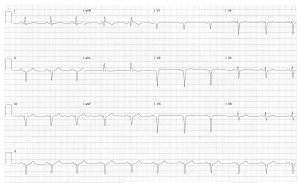 Heartbeat ECG 