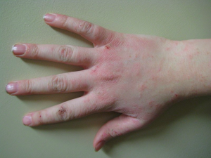 Healthline Rash