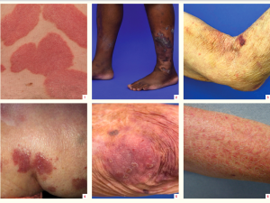 Examples of psoriasis