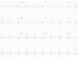 Heartbeat ECG